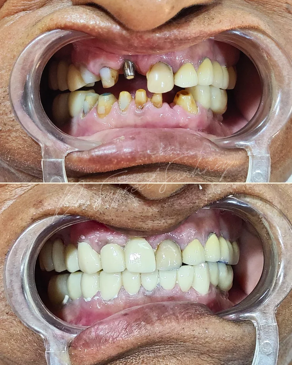 Before-and-after frontal intraoral photographs from a full-arch implant-supported rehabilitation case